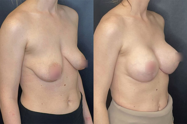 before and after breast augmentation with lift female patient right angled view