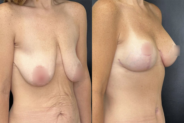 before and after breast augmentation with lift right angled view