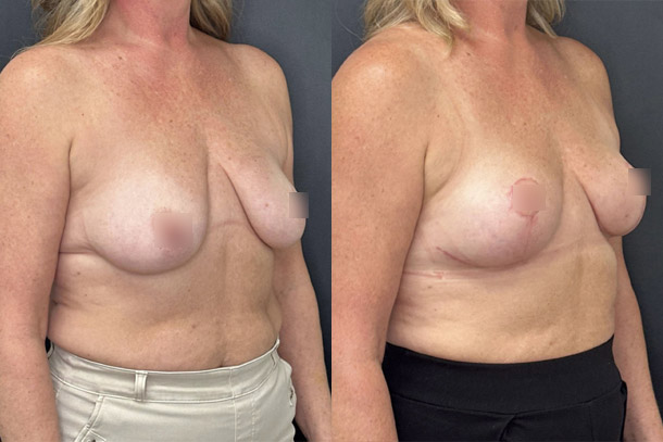before and after breast lift female patient right angled view