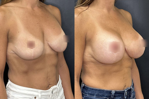 before and after breast implant replacement female patient right angled view