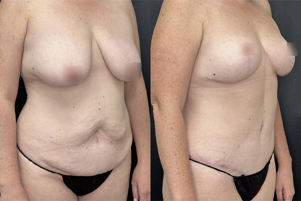 before and after mommy makeover female patient right angled view