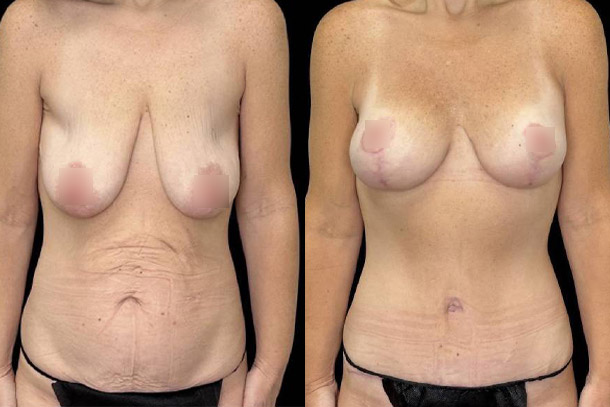 before and after mommy makeover female patient front view