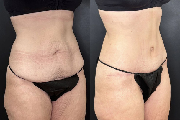 before and after tummy tuck female patient right angled view