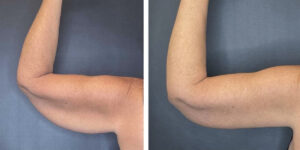 before and after arm lift left arm back view female patient case 1676