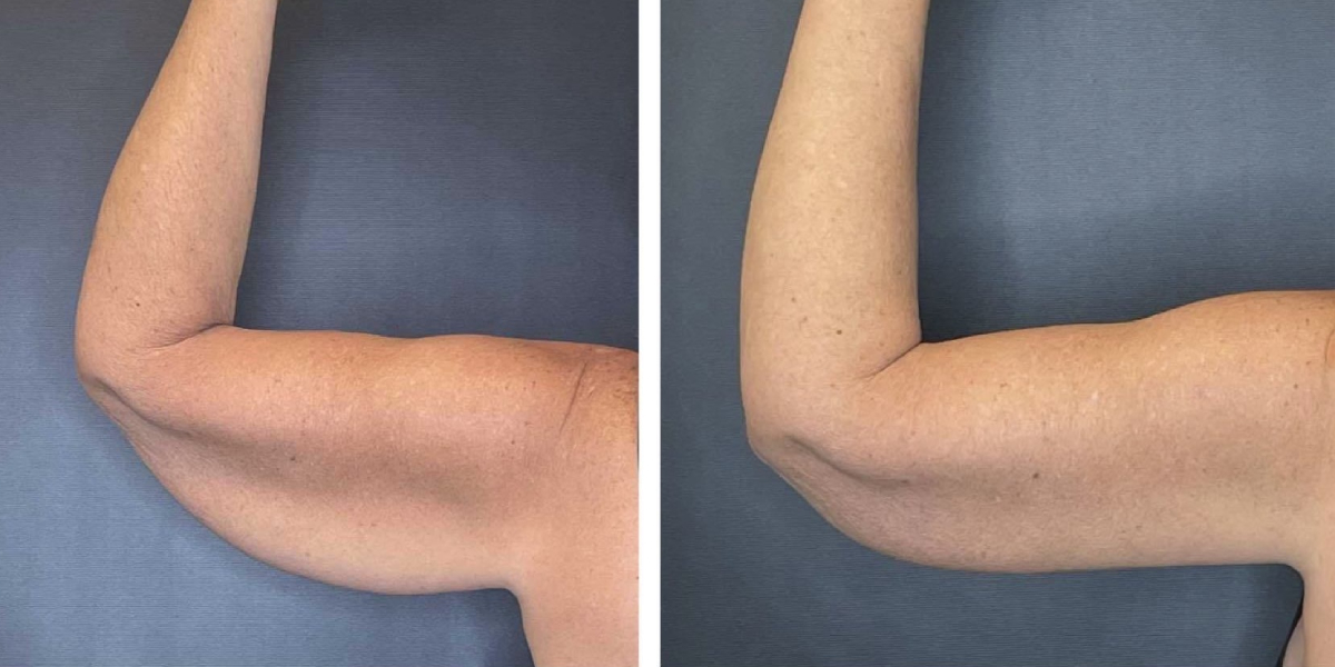 before and after arm lift left arm back view female patient case 1676