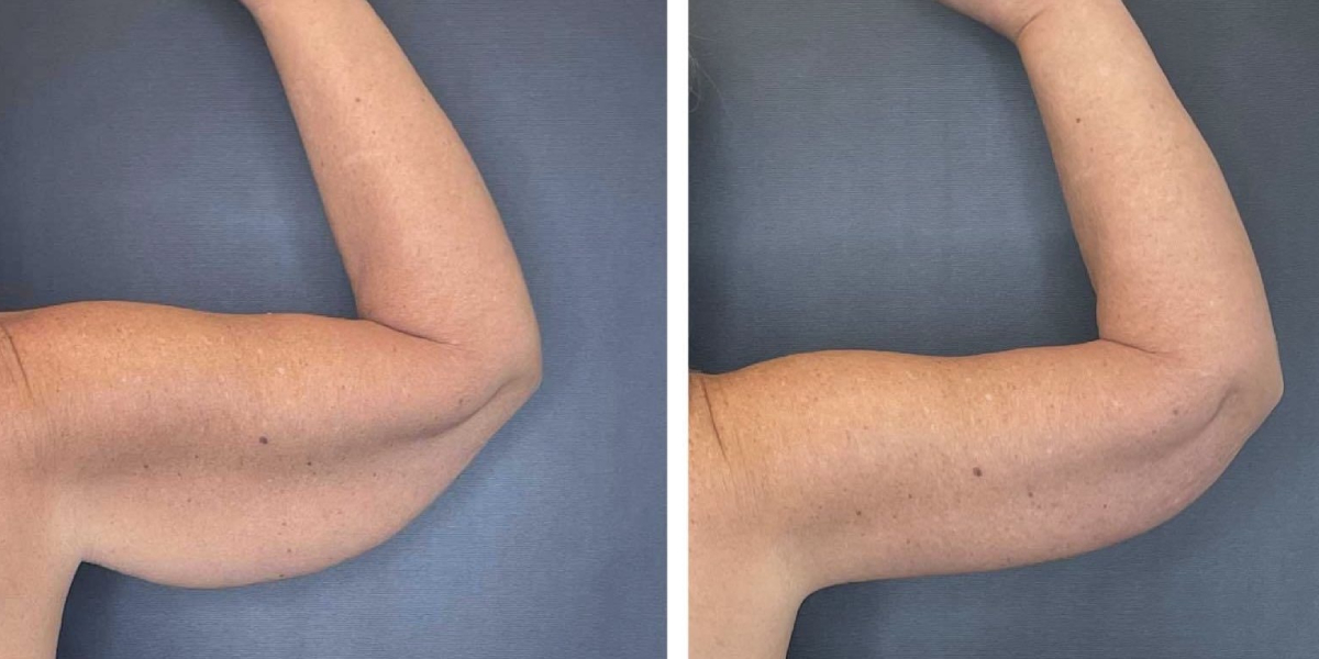 before and after arm lift right arm back view female patient case 1676