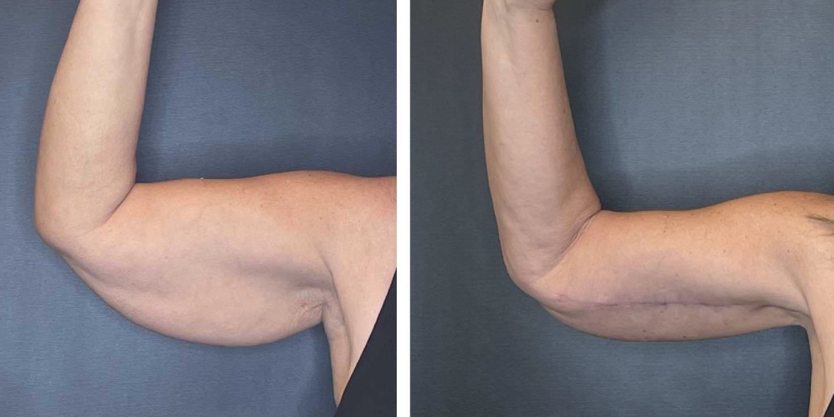 before and after arm lift right arm front view female patient case 1676