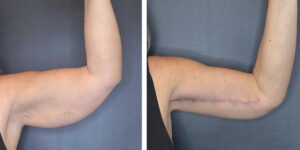 before and after arm lift left arm front view female patient case 1676