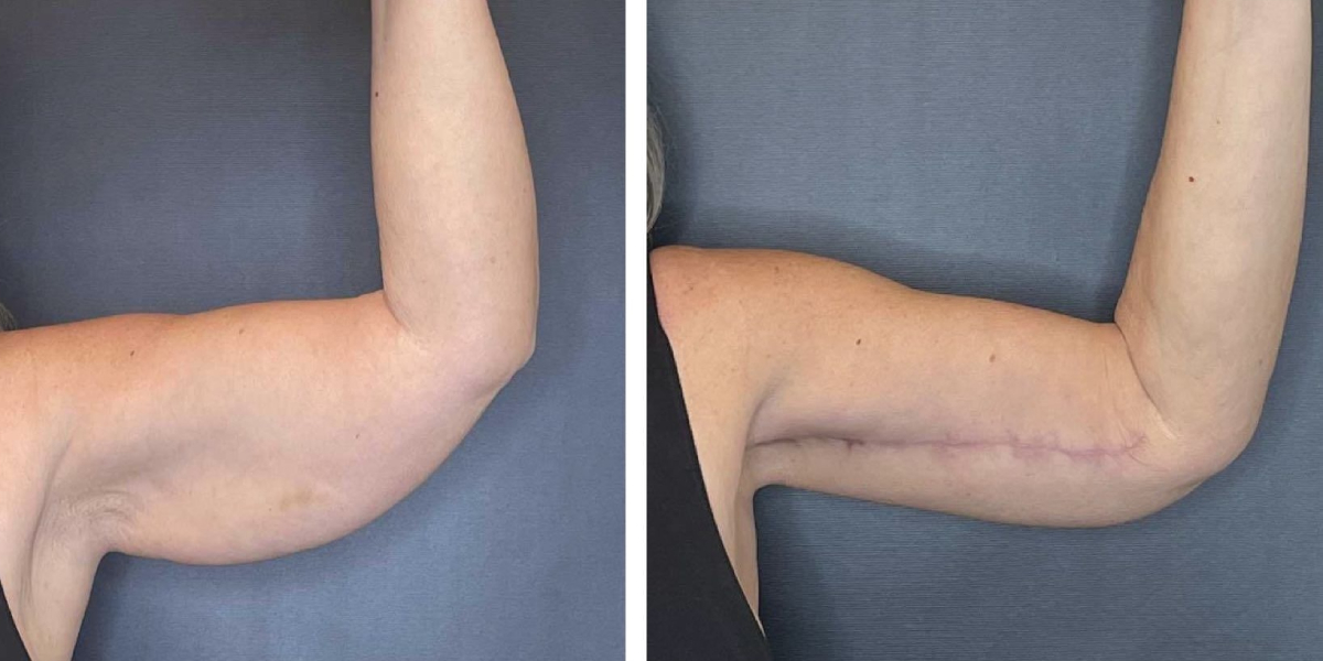 before and after arm lift left arm front view female patient case 1676
