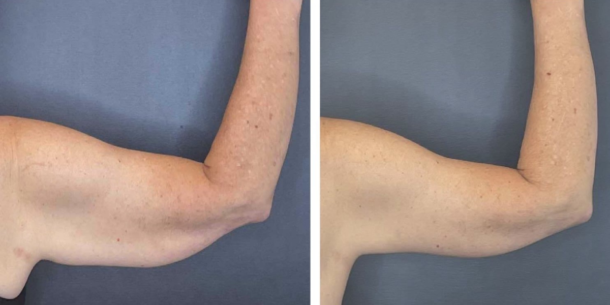 before and after arm lift right back view female patient case 1681