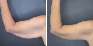 before and after arm lift left back view female patient case 1681