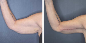 before and after arm lift right arm front view female patient case 1681