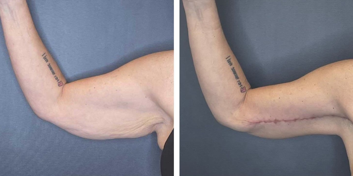 before and after arm lift right arm front view female patient case 1681