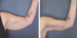 before and after arm lift left side front view female patient case 1681