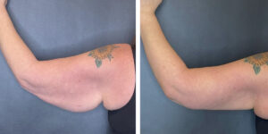 before and after arm lift left back view female patient case 1686