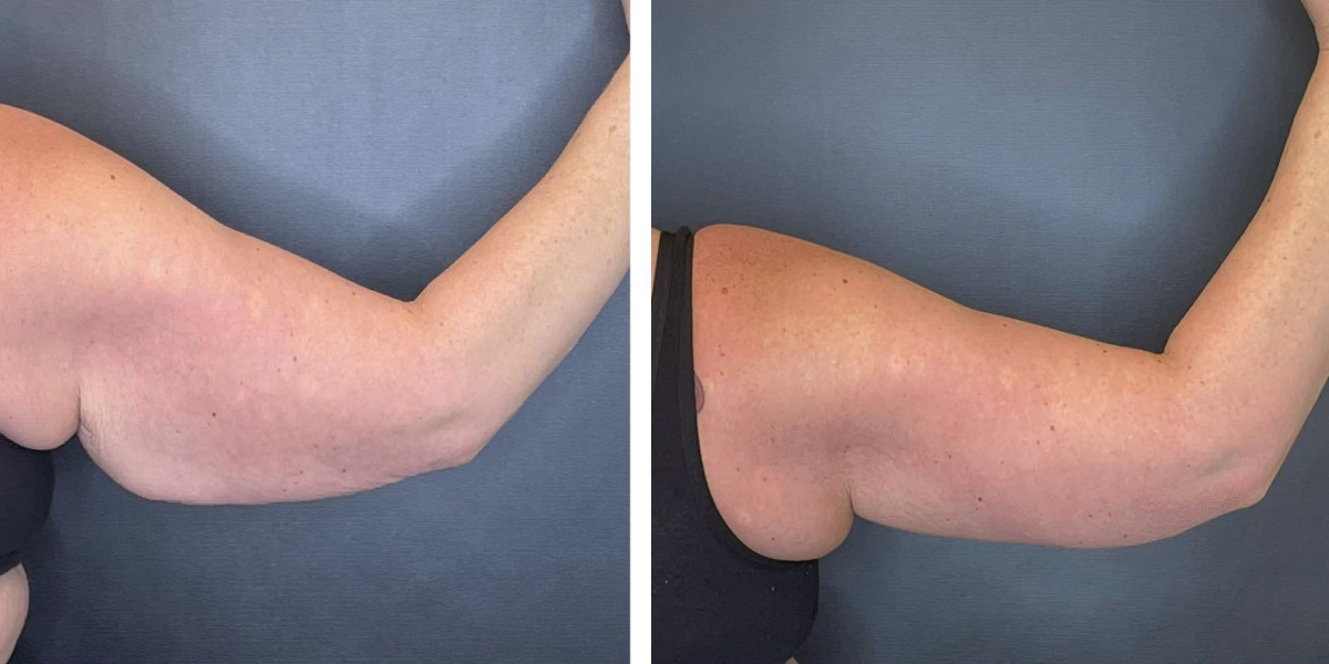 before and after arm lift right back view female patient case 1686