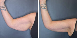 before and after arm lift right arm front view female patient case 1686