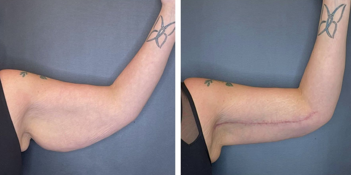 before and after arm lift left arm front view female patient case 1686