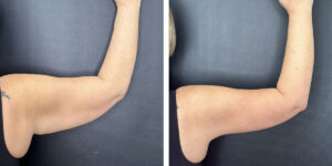 before and after arm lift right arm back view female patient case 1696