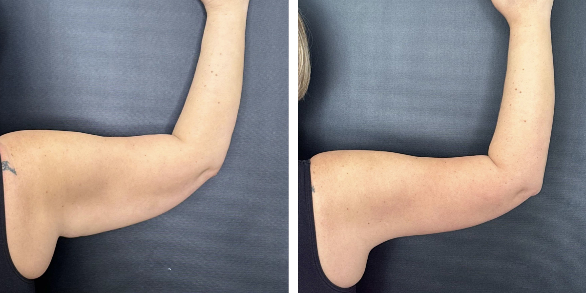 before and after arm lift right arm back view female patient case 1696