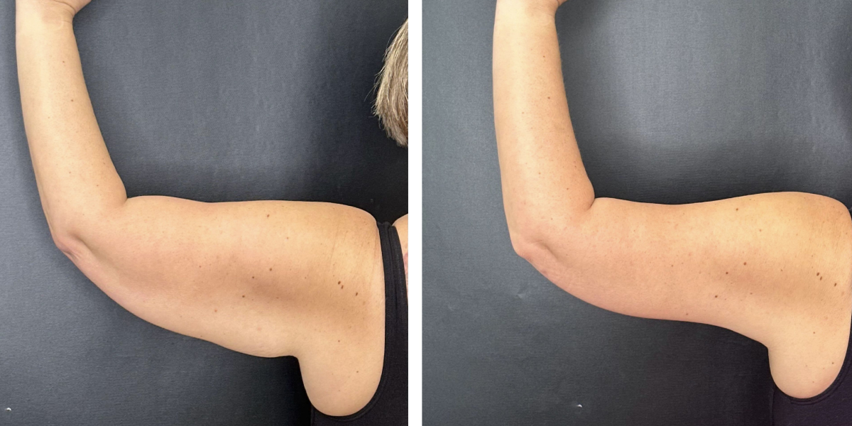 before and after arm lift left arm back view female patient case 1696