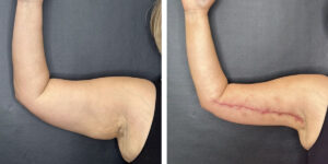 before and after arm lift right arm front view female patient case 1696
