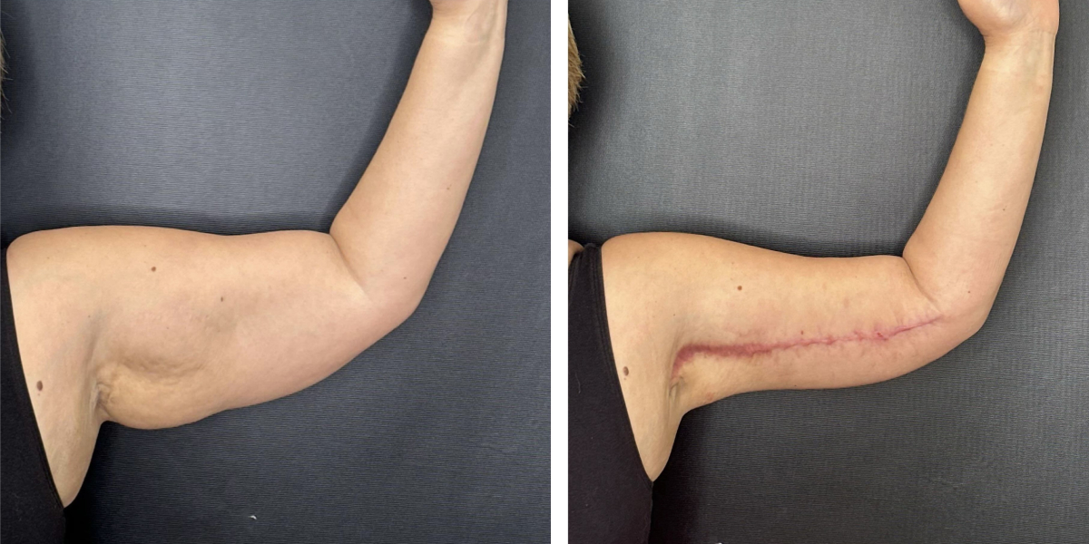 before and after arm lift left arm front view female patient case 1696