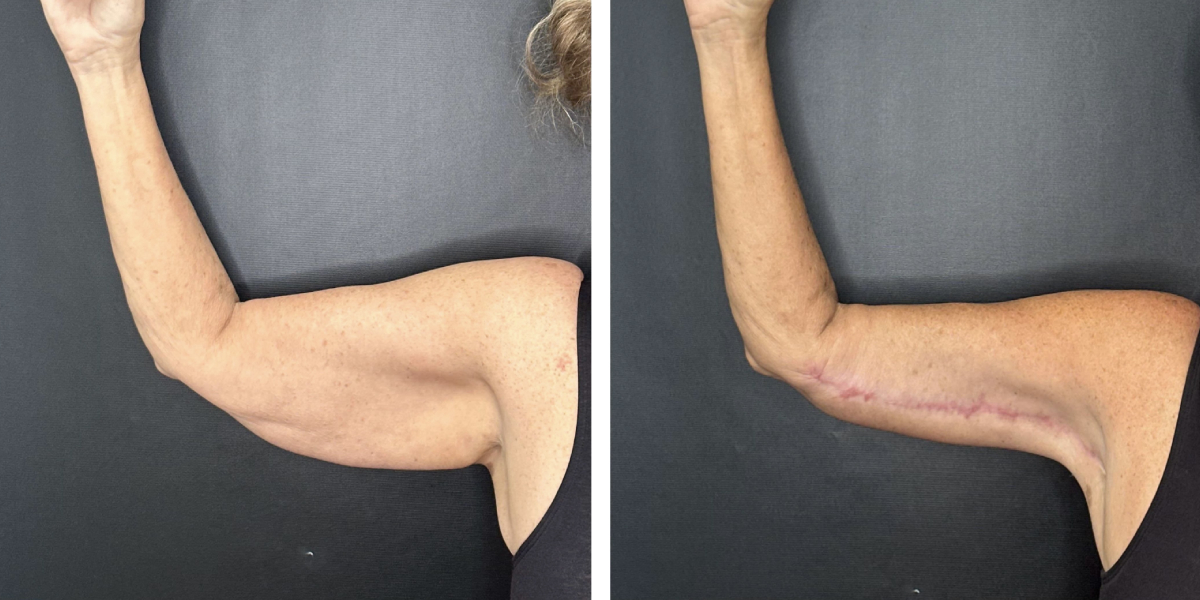 before and after arm lift right arm front view female patient case 1701
