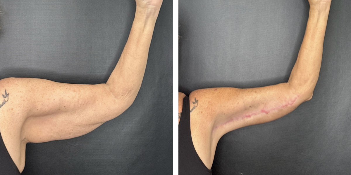 before and after arm lift left arm front view female patient case 1701