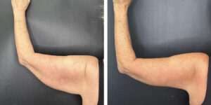 before and after arm lift left arm back view female patient case 1701