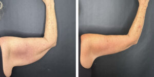 before and after arm lift right arm back view female patient case 1701