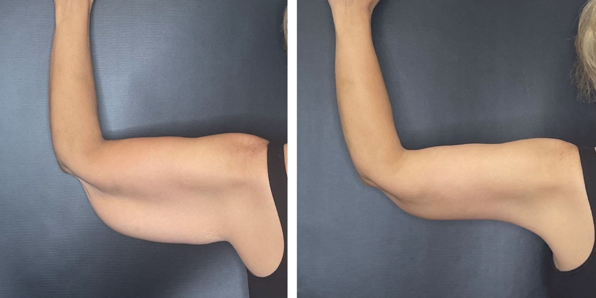 before and after arm lift right arm back view female patient case 1706