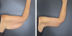 before and after arm lift left arm back view female patient case 1706