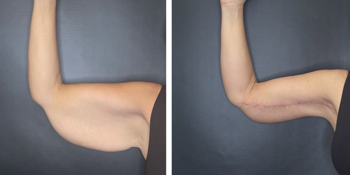 before and after arm lift right arm front view female patient case 1706