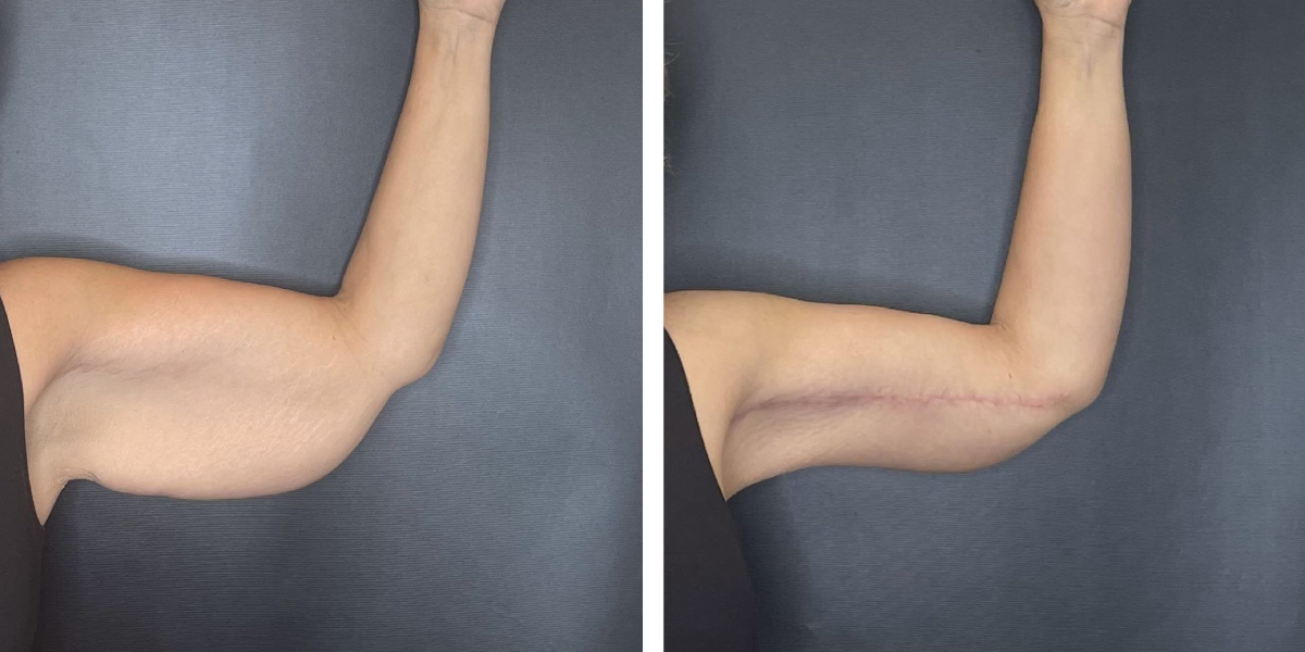 before and after arm lift right arm front view female patient case 1706