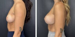 before and after breast augmentation female patient left side view case 1996
