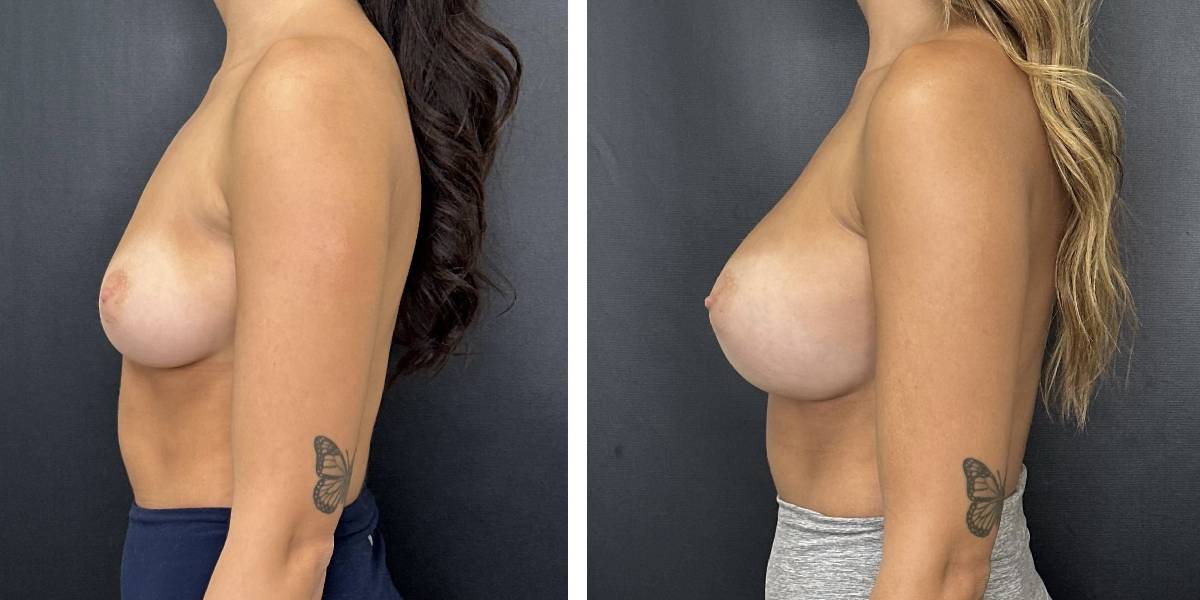 before and after breast augmentation female patient left side view case 1996