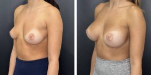 before and after breast augmentation female patient left angled view case 1996