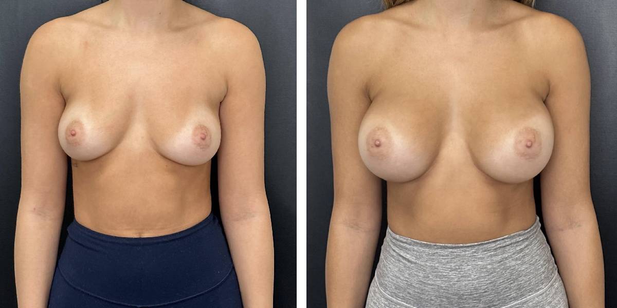 before and after breast augmentation female patient front view case 1996