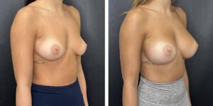 before and after breast augmentation female patient right angled view case 1996