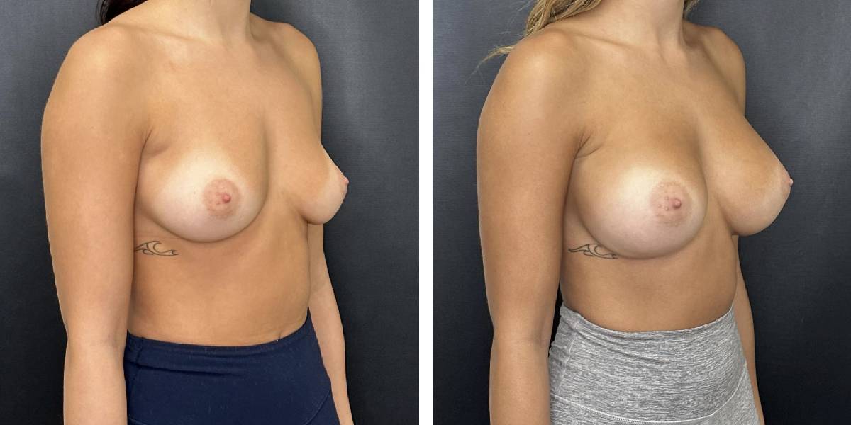 before and after breast augmentation female patient right angled view case 1996