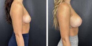 before and after breast augmentation female patient right side view case 1996