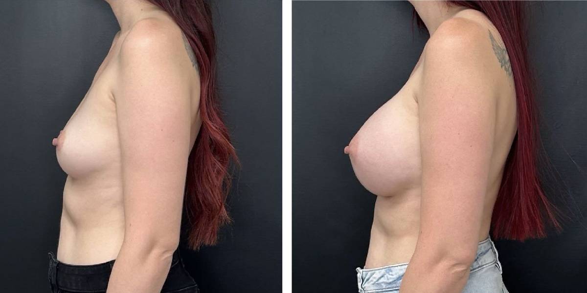 before and after breast augmentation female patient left side view case 2006