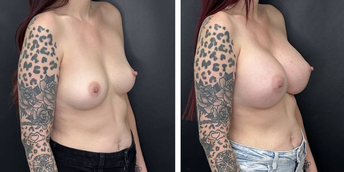 before and after breast augmentation female patient right angled view case 2006