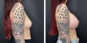 before and after breast augmentation female patient right side view case 2006