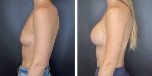before and after breast augmentation female patient left side view case 2012