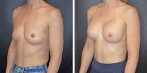 before and after breast augmentation female patient left angled view case 2012