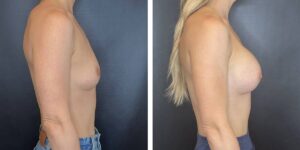 before and after breast augmentation female patient right side view case 2012
