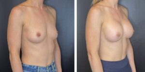 before and after breast augmentation female patient right angled view case 2012