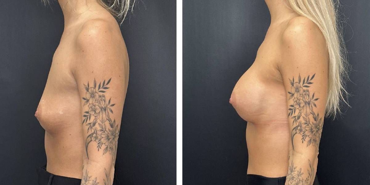 before and after breast augmentation female patient left side view case 2018